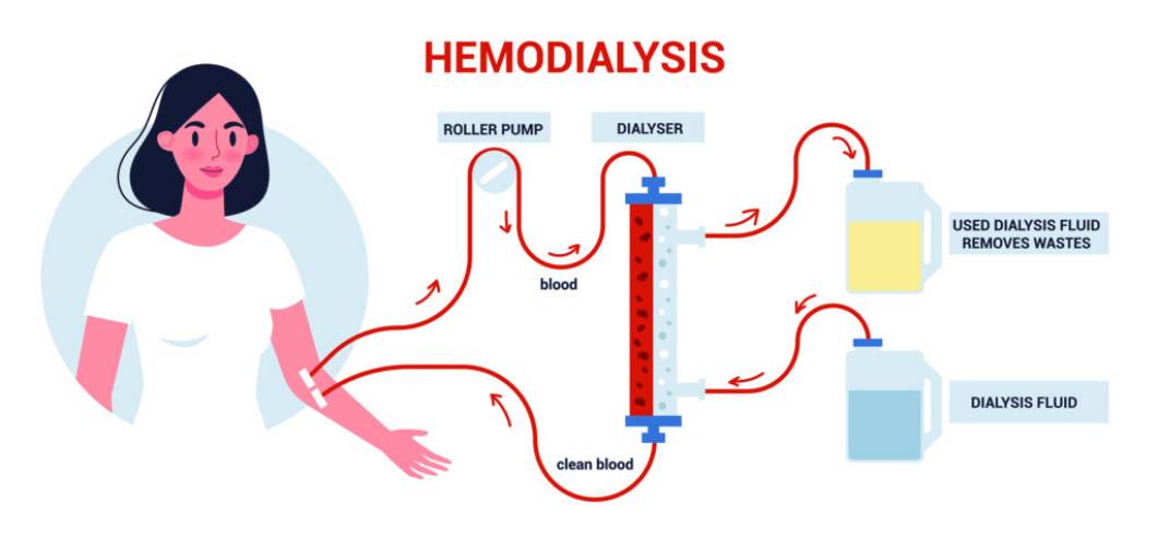 hemodialysis