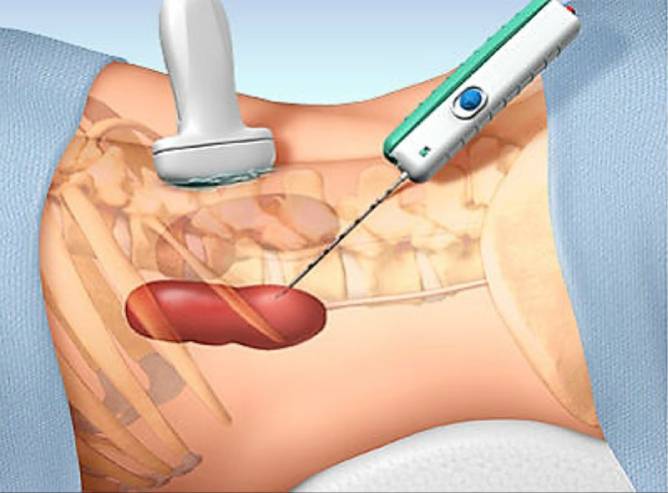 Kidney-Biopsy